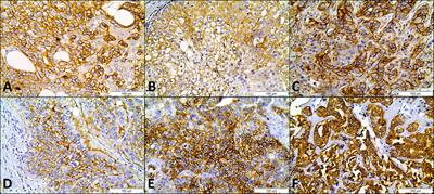 Expression of Glycolysis-Related Proteins in Cancer of Unknown Primary Origin